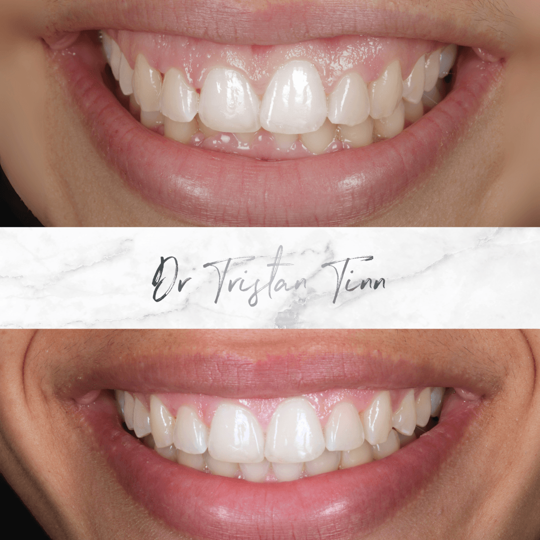 Aligners + Whitening