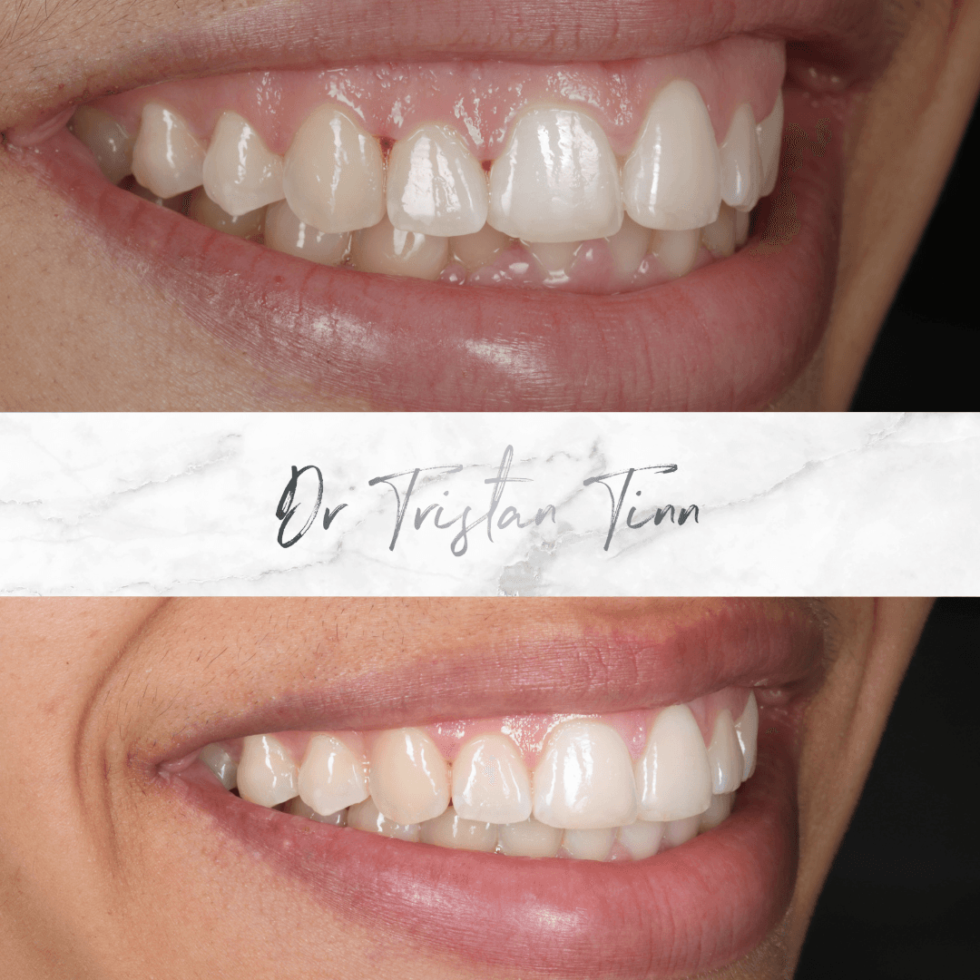 Aligners + Whitening