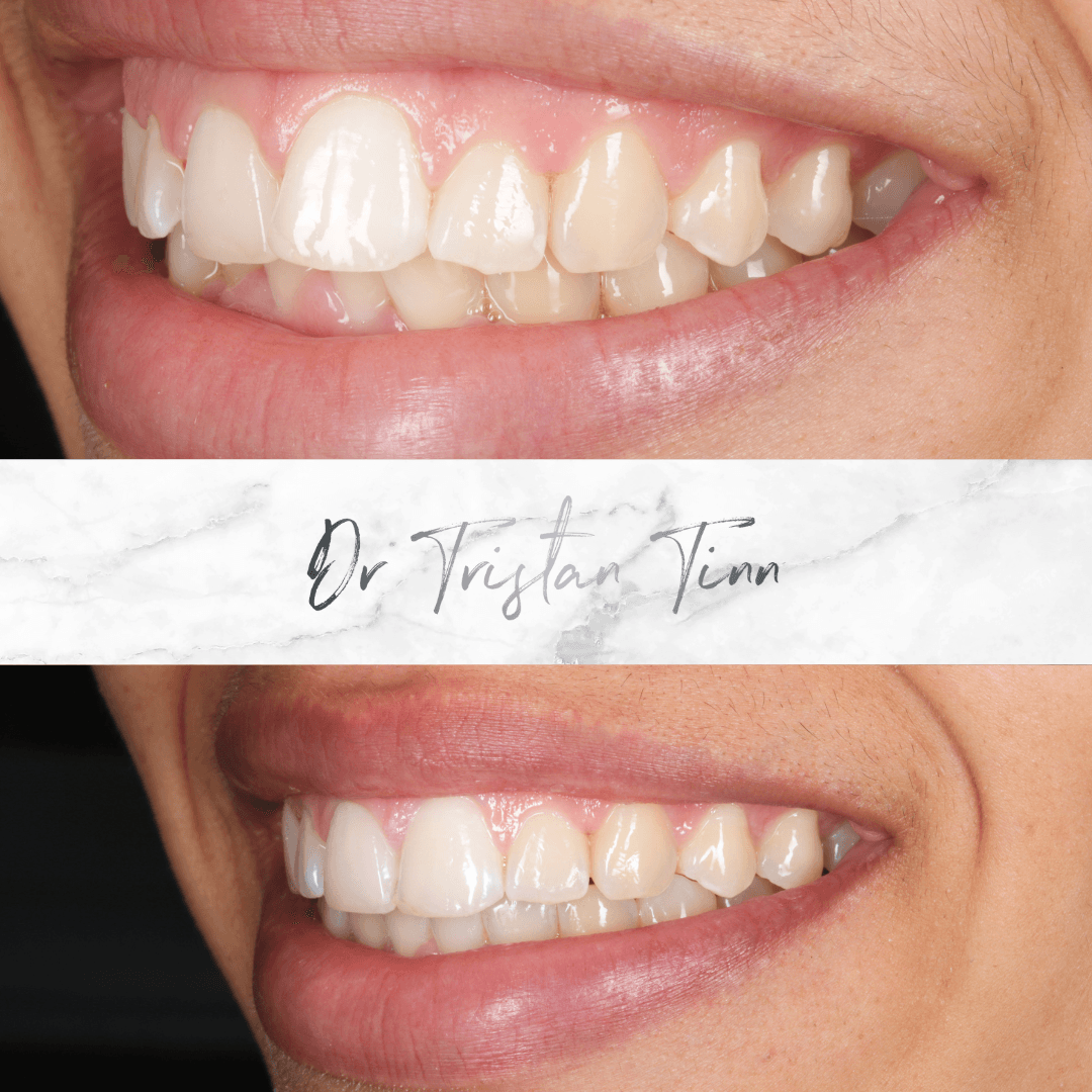 Aligners + Whitening