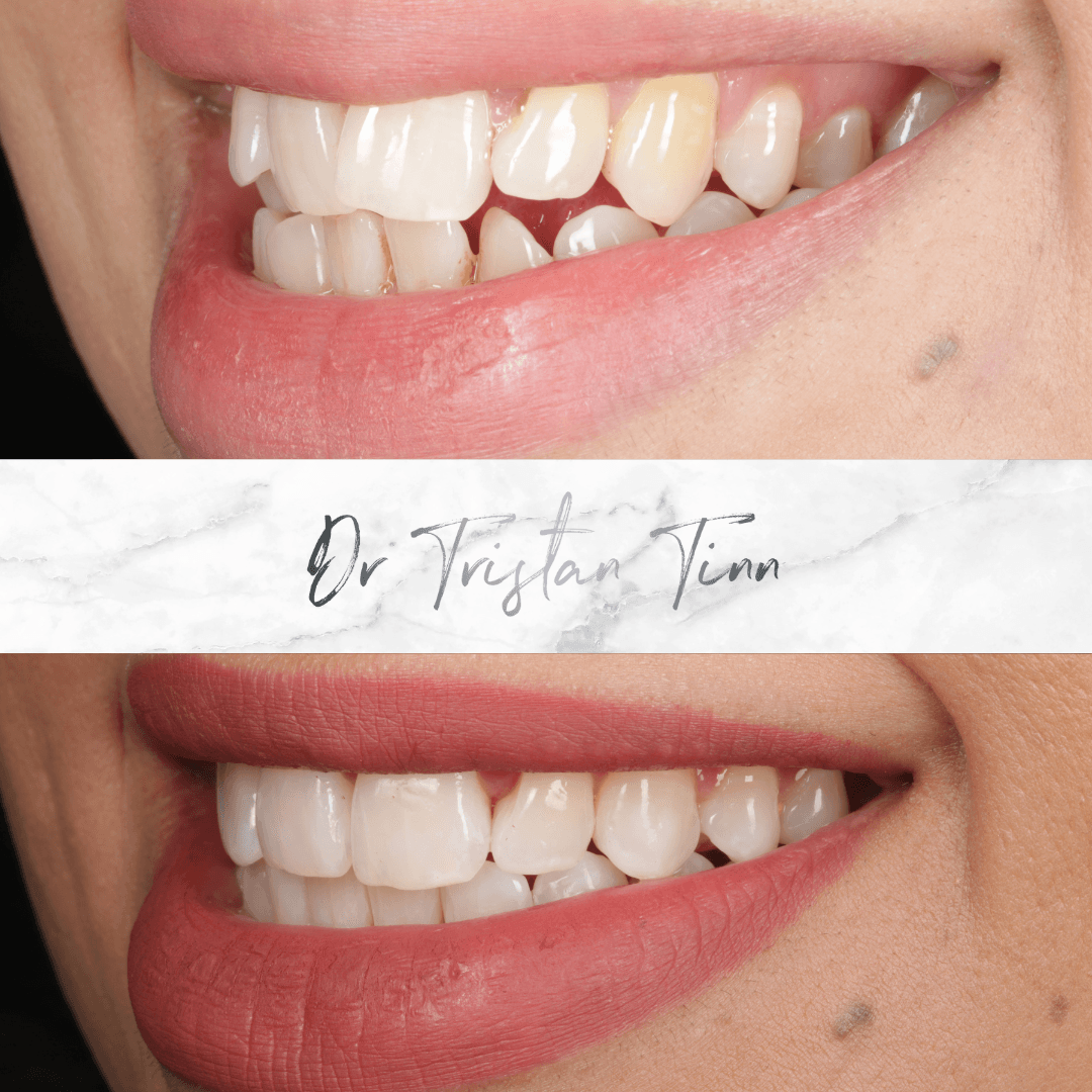 Aligners + Whitening + Bonding