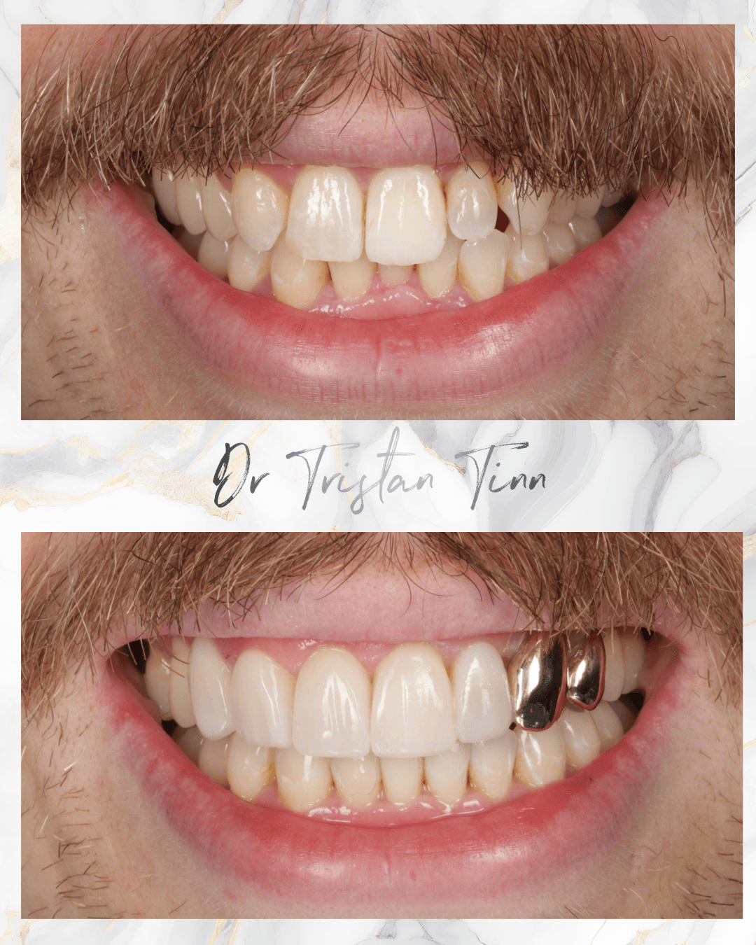 Aligners + Whitening + Bonding + Ceramic Veneers