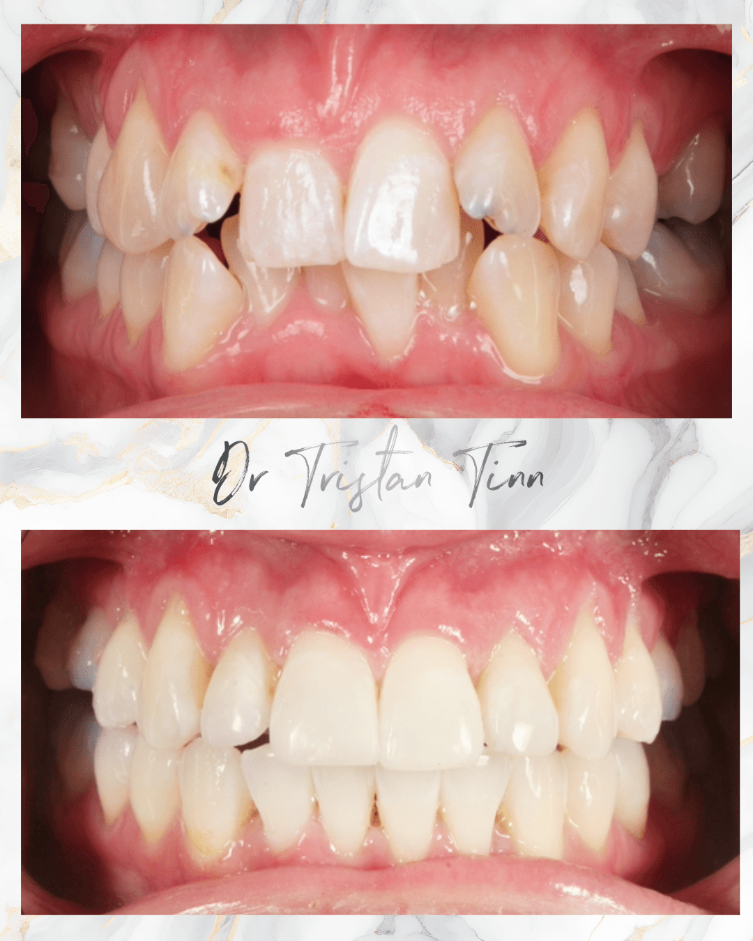 Aligners + Whitening + Bonding + Edge Bonding