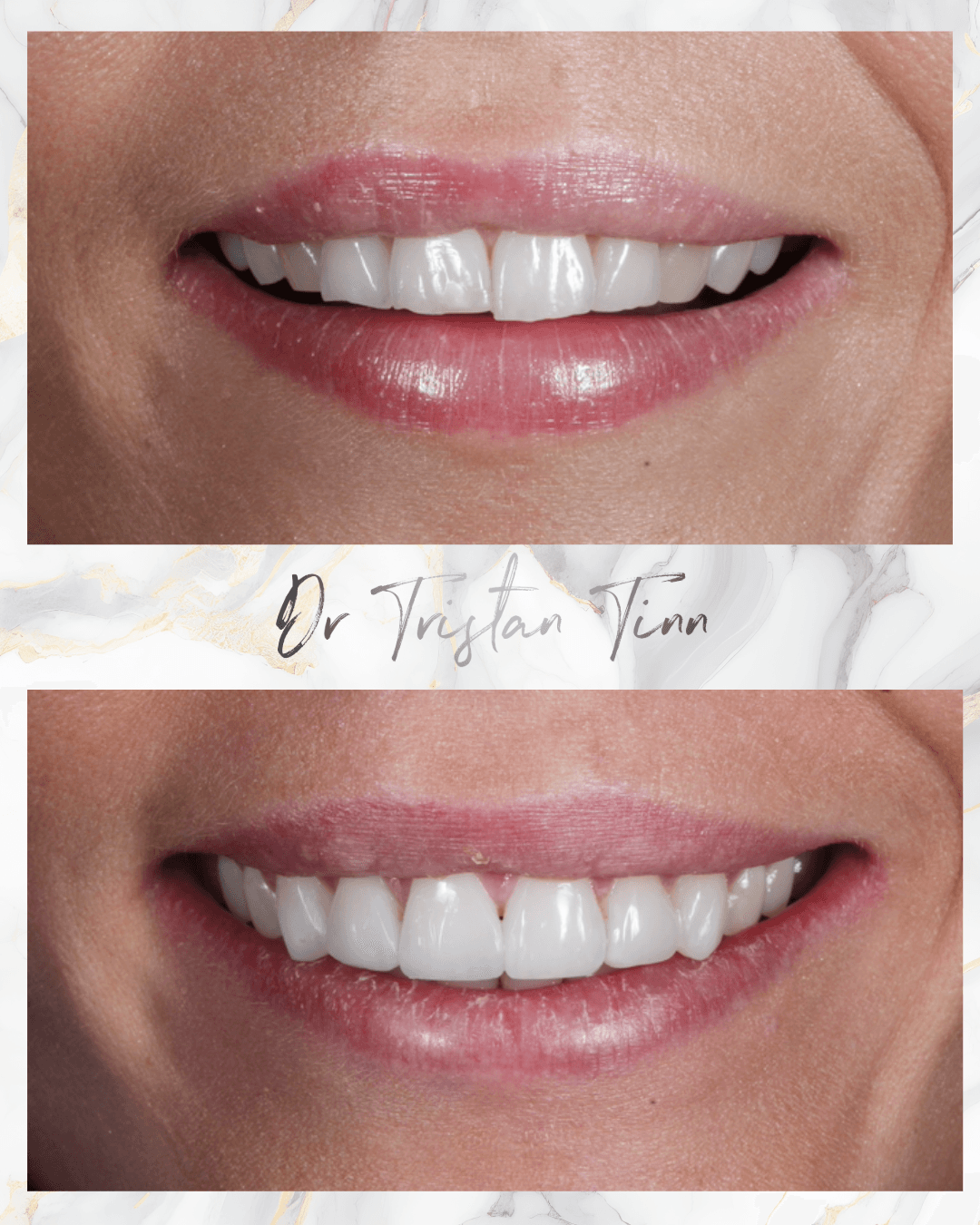 Aligners + Whitening + Bonding + Edge Bonding