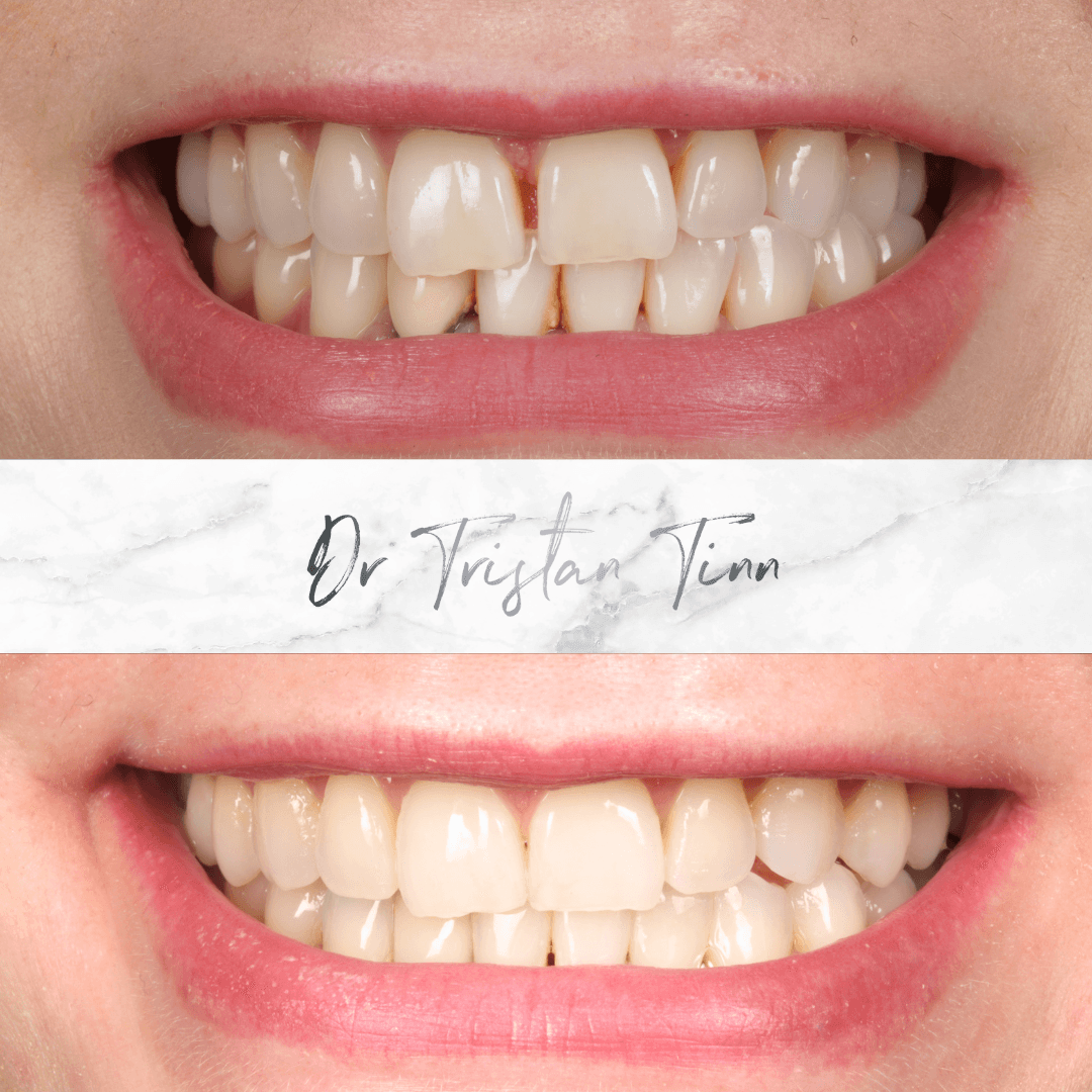 Aligners + Whitening + Bridge Replacement
