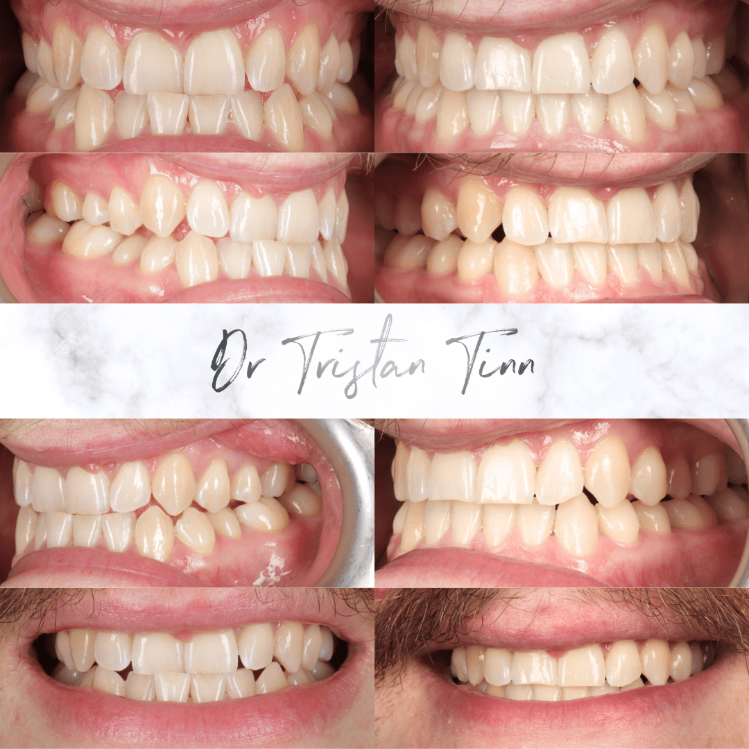 Aligners for Bite Correction