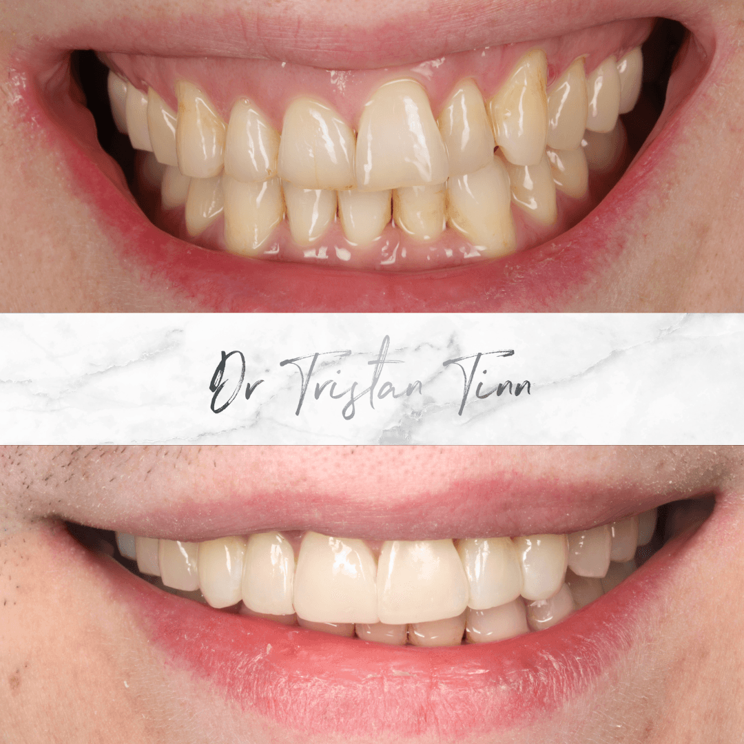 Aligners + Whitening + Edge Bonding