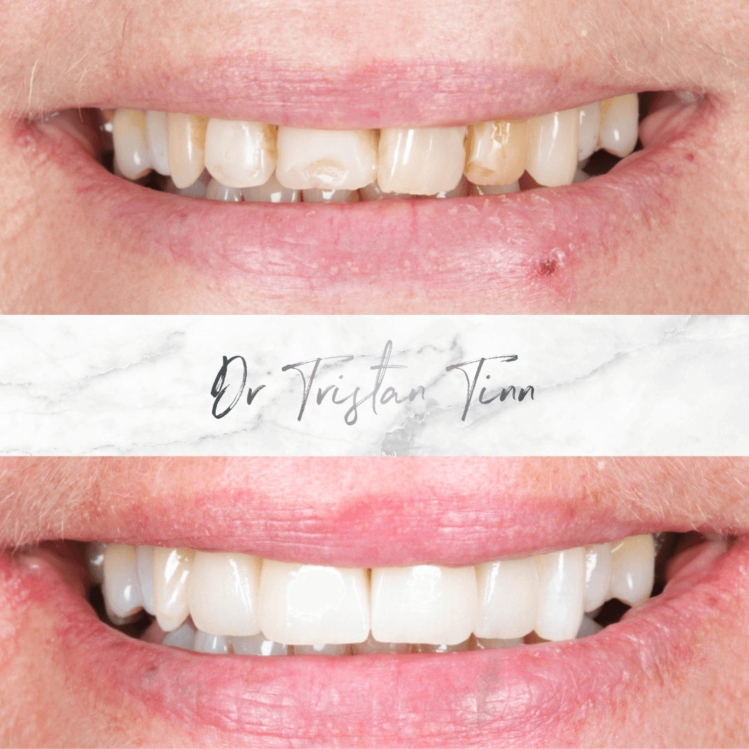 Ceramic Veneers