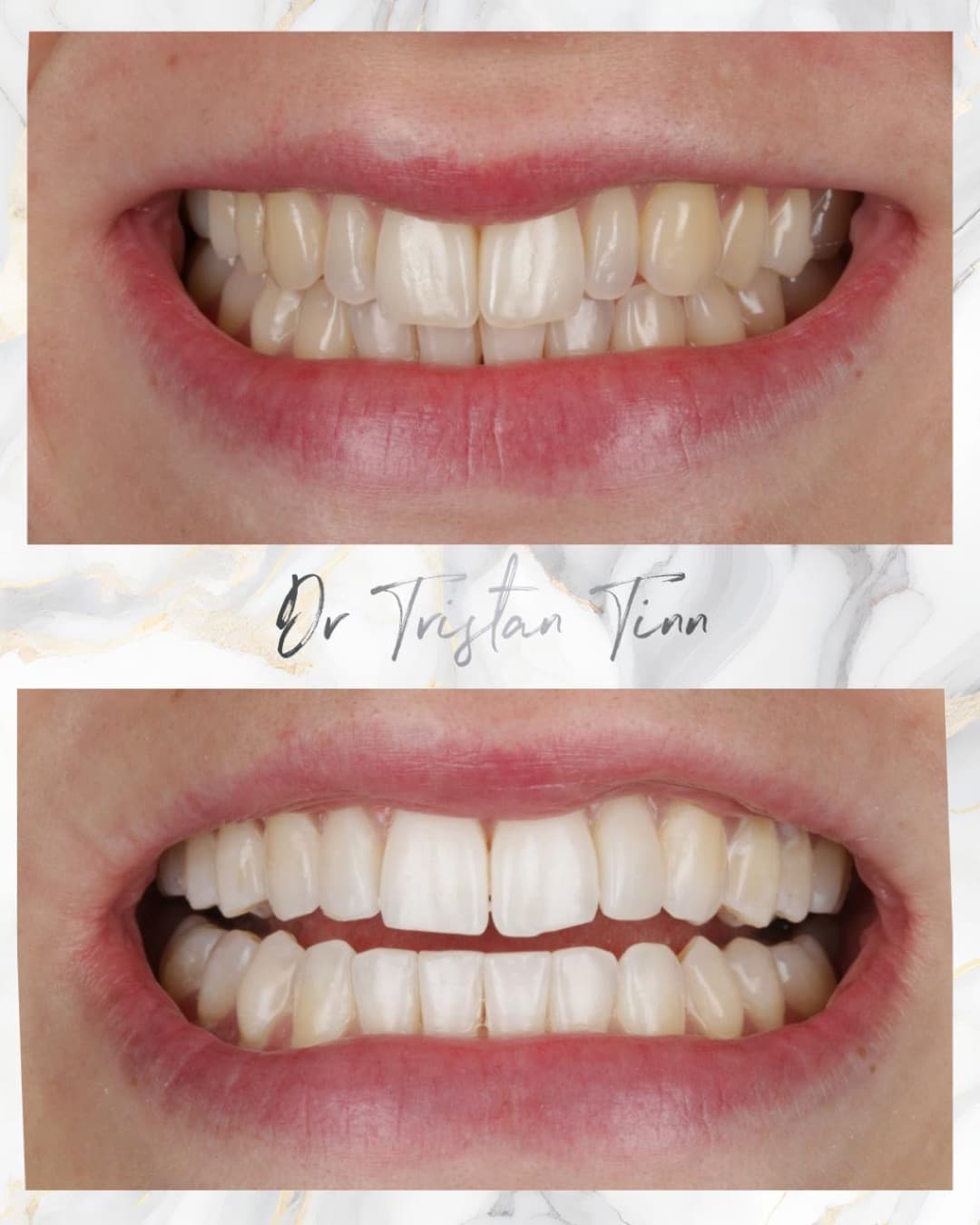 Aligners + Whitening