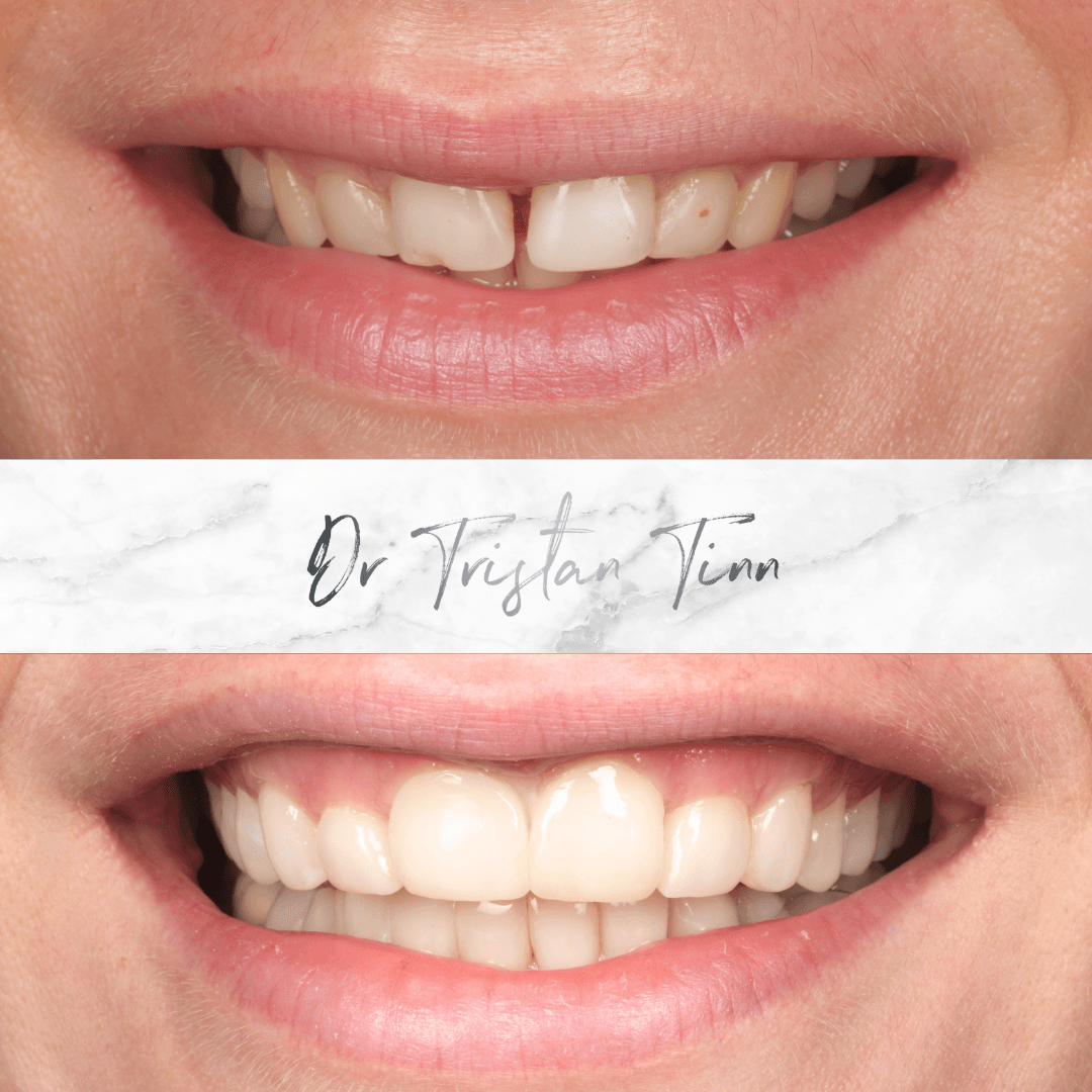 Composite Full Mouth Rehabilitation