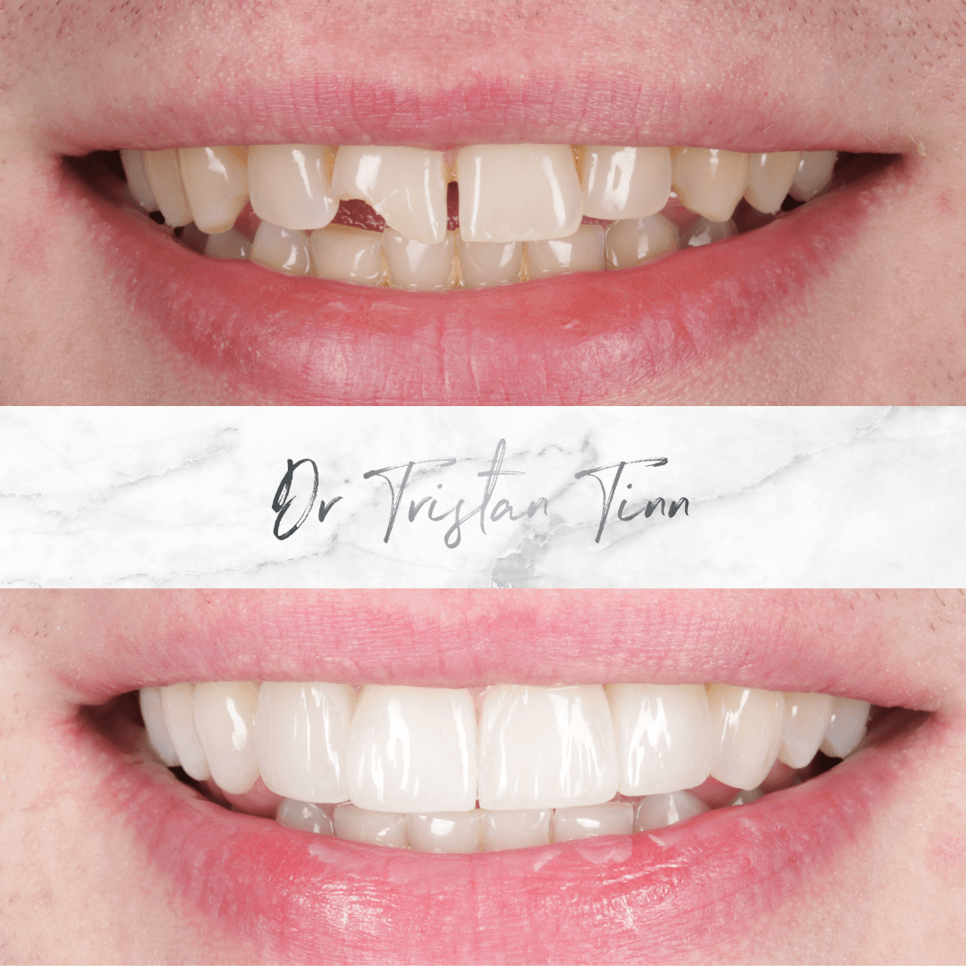 Composite Veneers