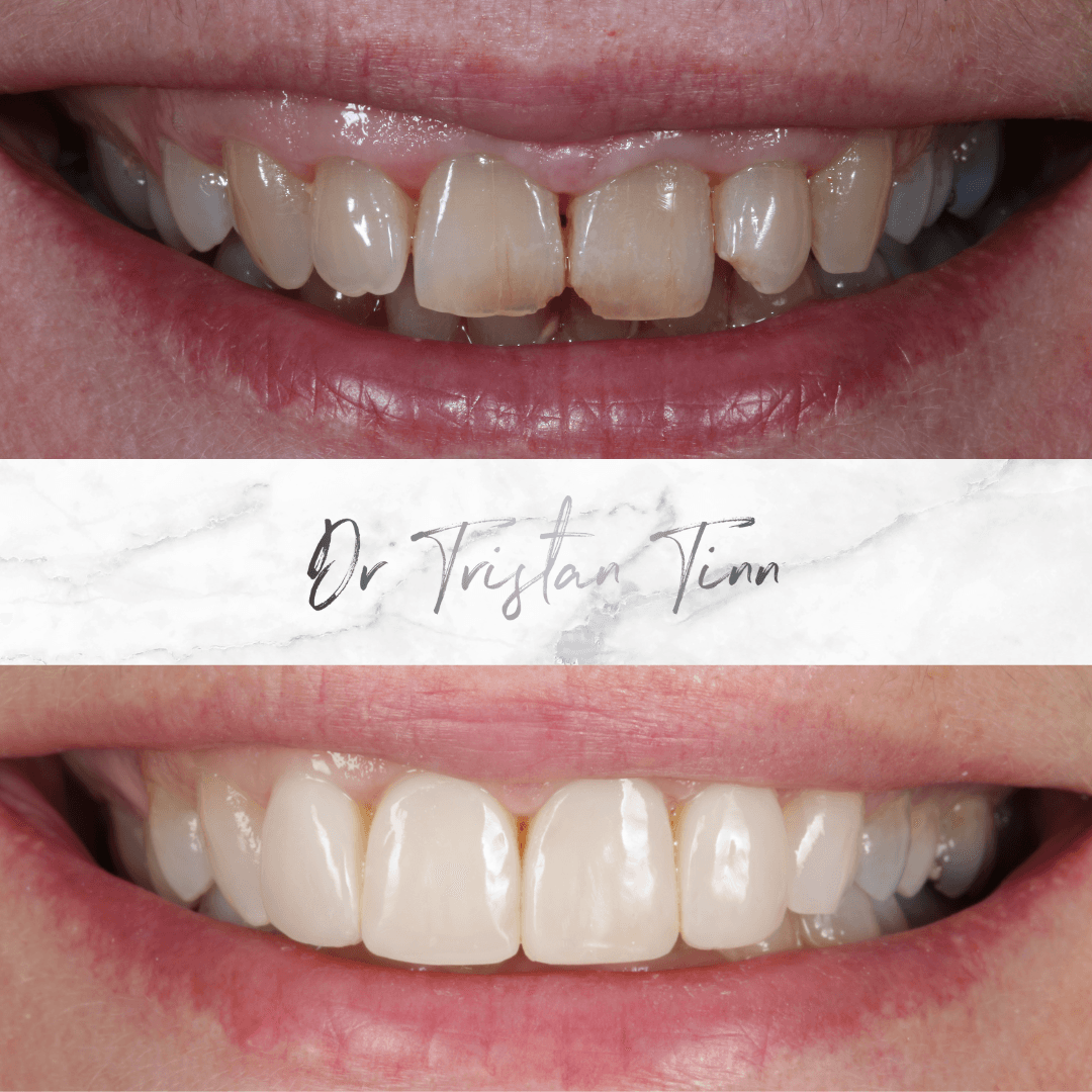 Composite Veneers