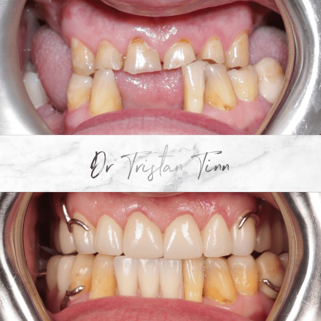 Crowns + Chrome Denture
