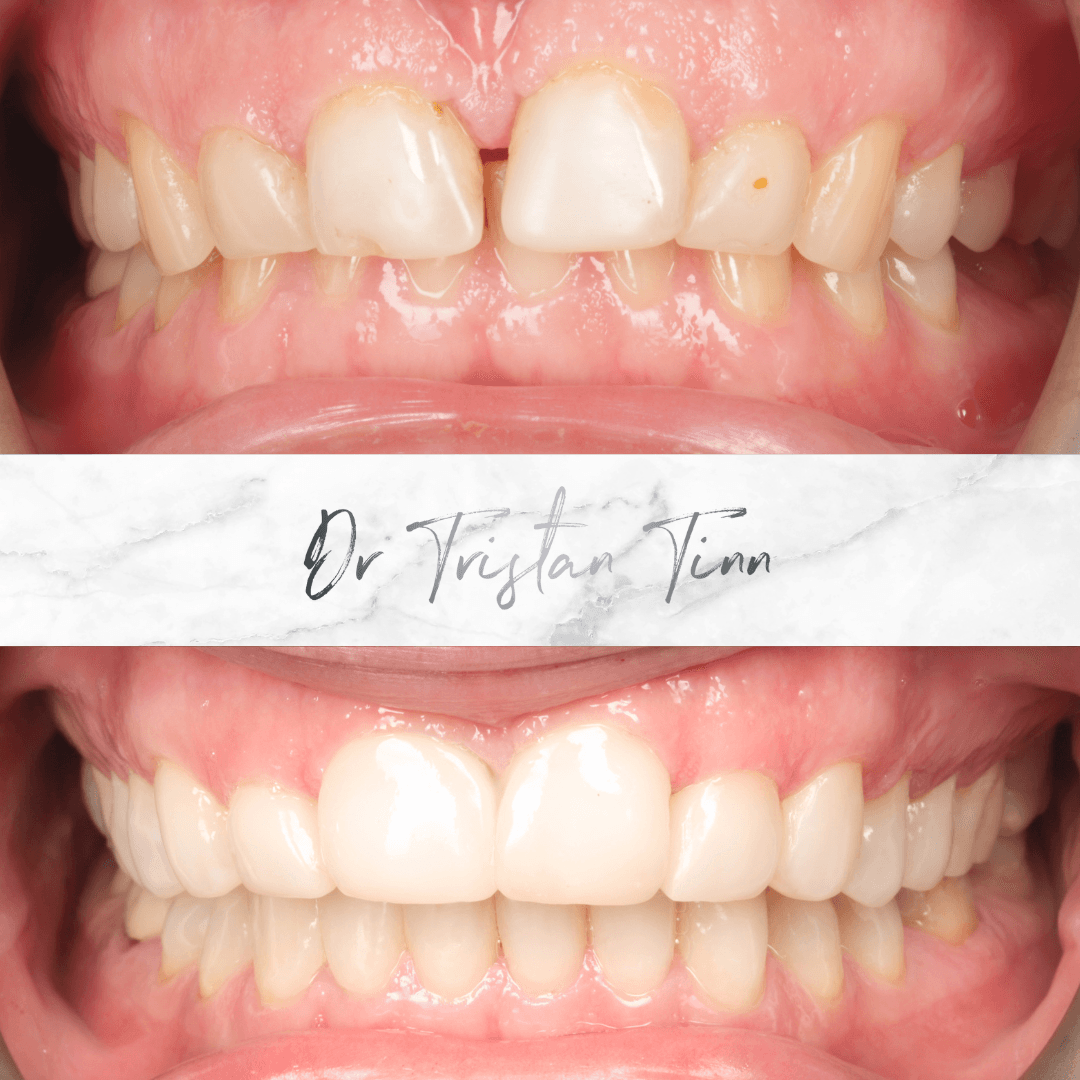 Direct Composite Rehabilitation