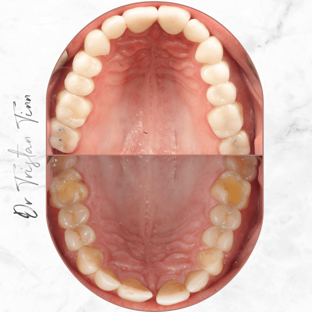 Full Mouth Composite Rehabilitation