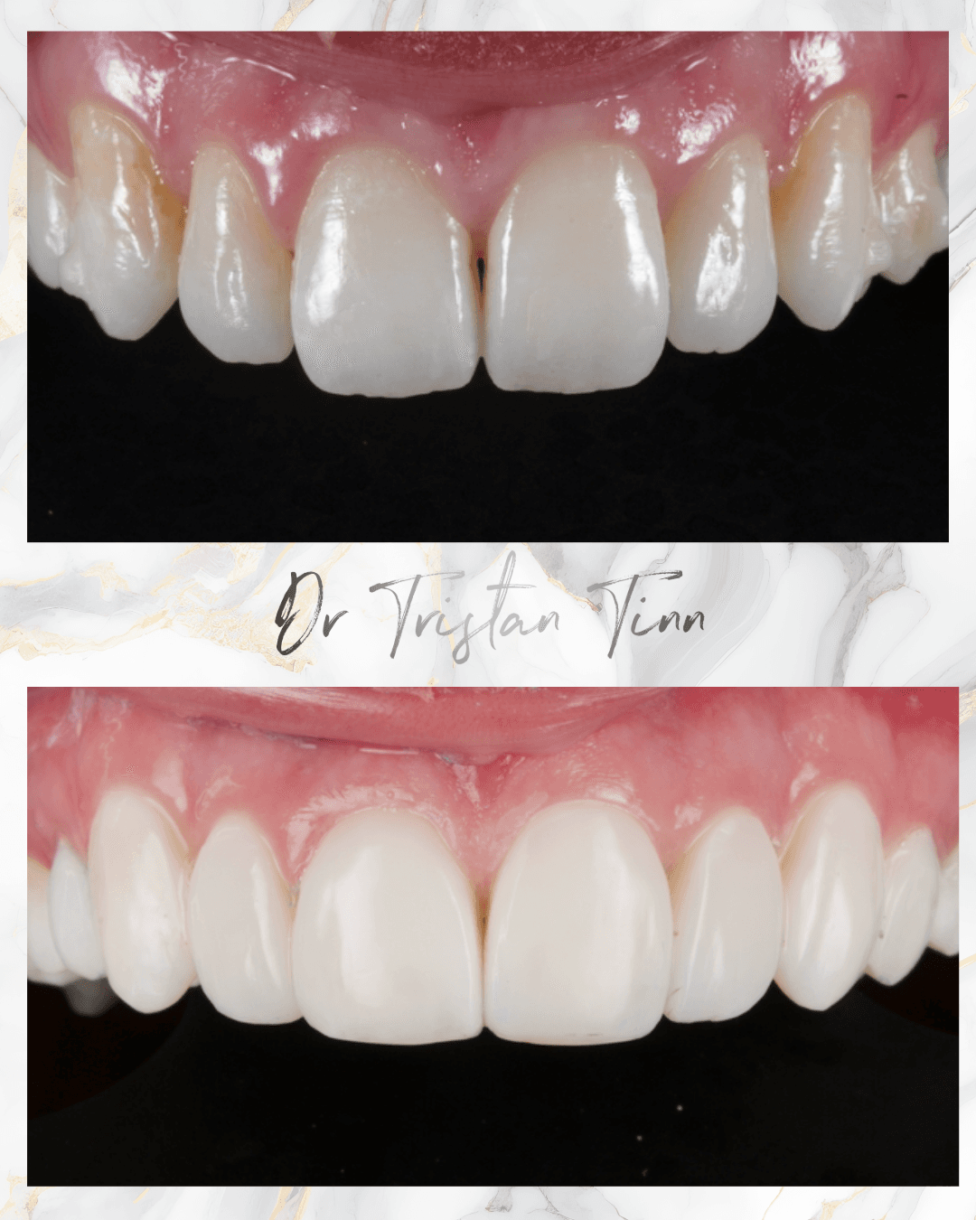 Bright White Composite Veneers