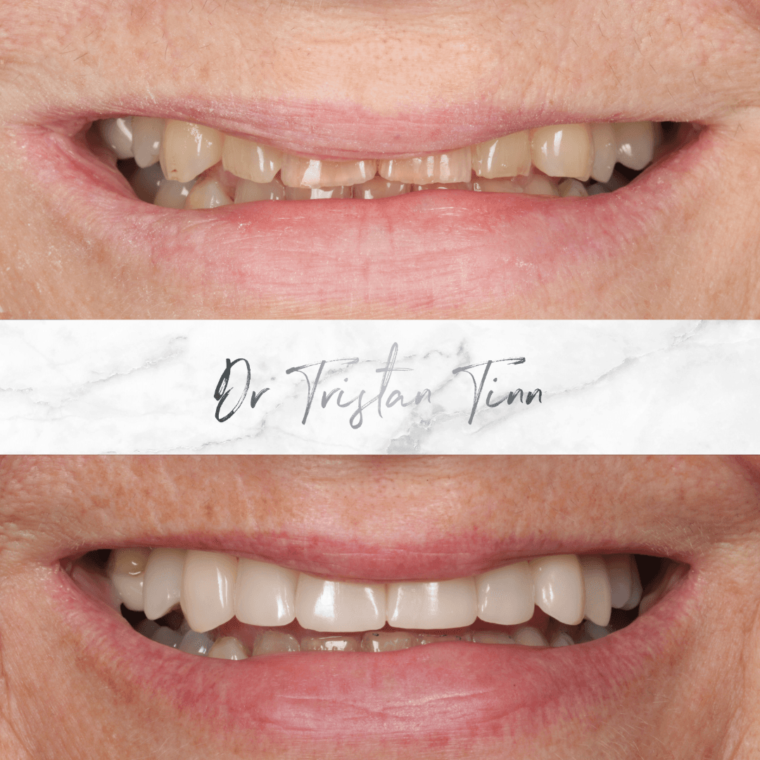 Ceramic Veneers
