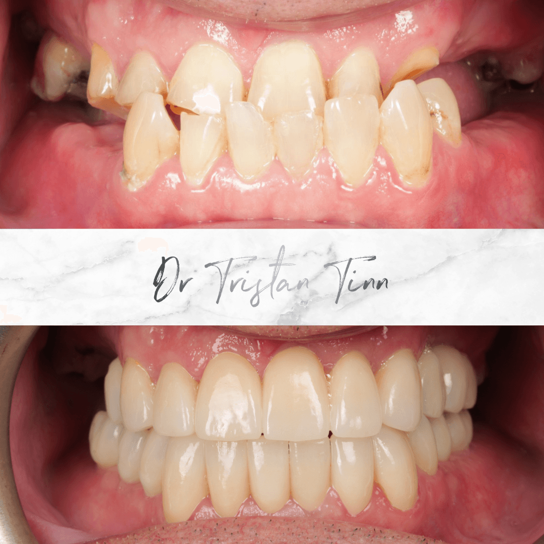 Full Mouth Crown Rehabilitation
