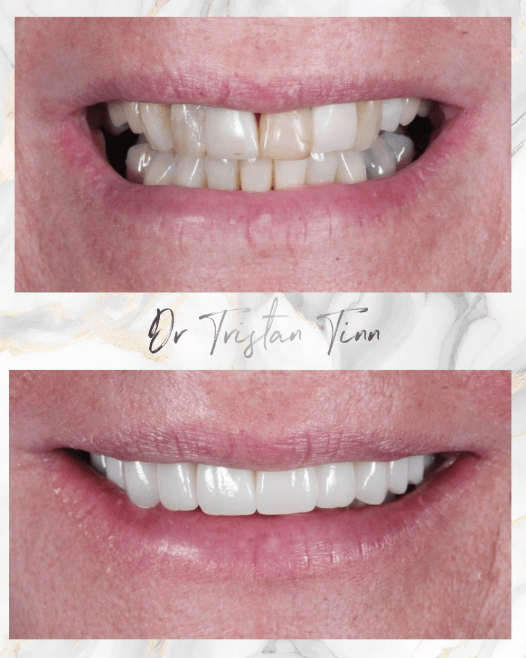 Full Mouth Rehabilitation