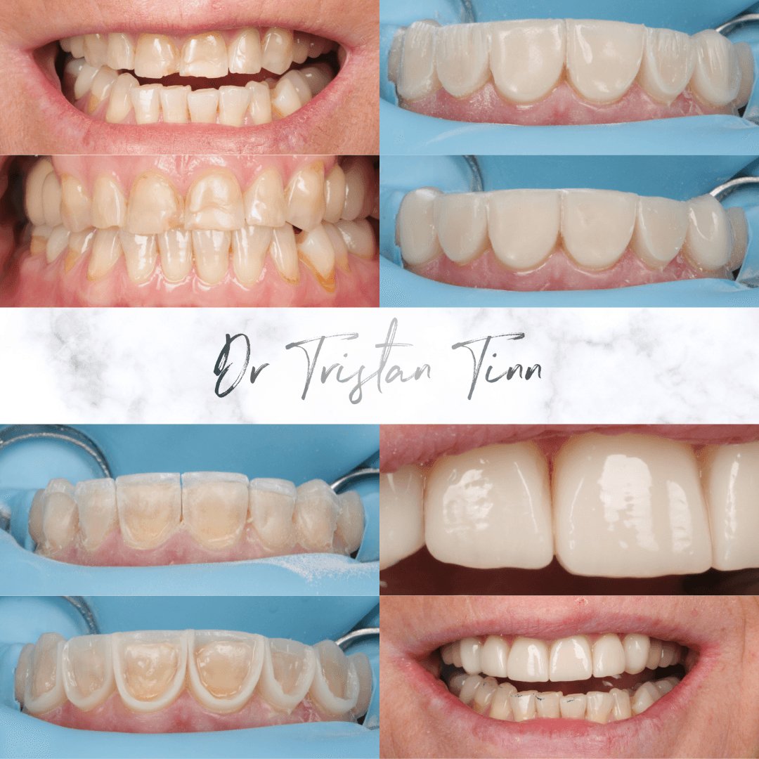 Composite Veneers for Worn Teeth